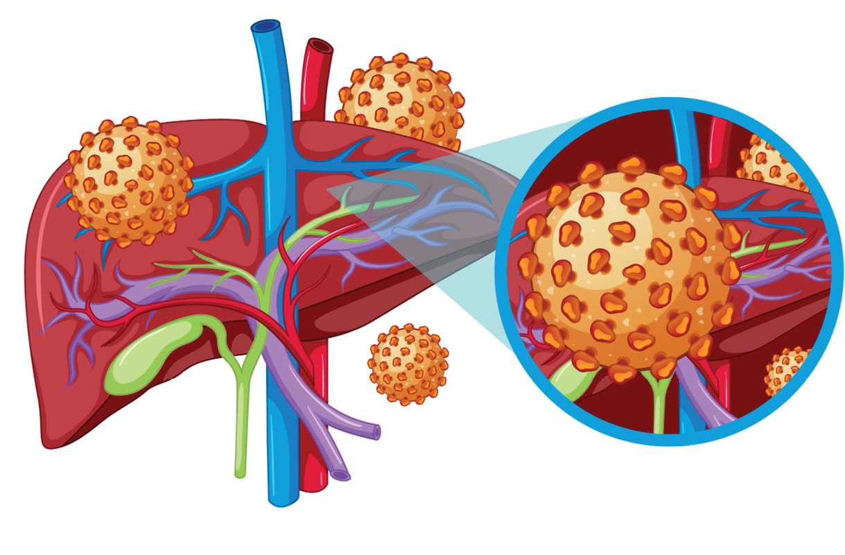 How to Prevent Hepatitis