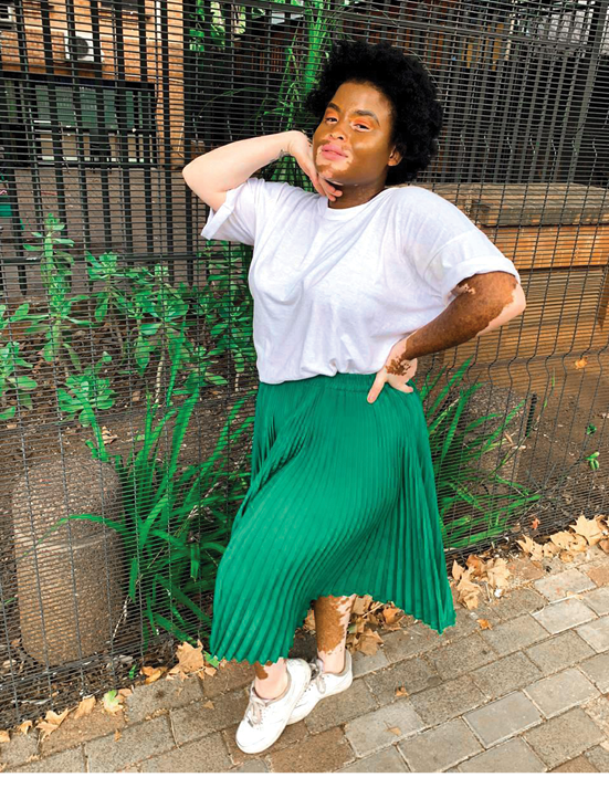 Otshepeng Mmutloane has been living with vitiligo since she was four years old.