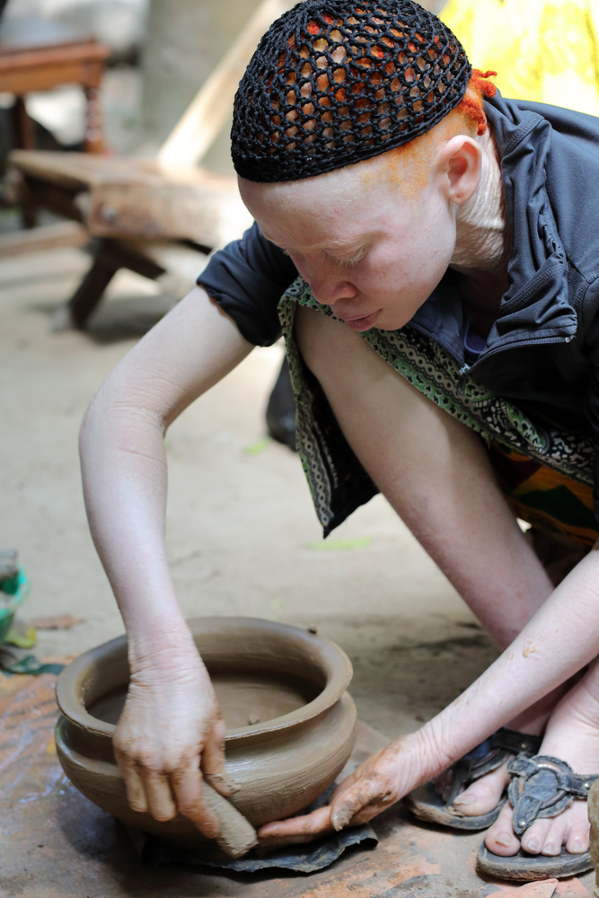 Albinism is a condition that reduces the amount of melanin pigment formed in the skin, hair or eyes.